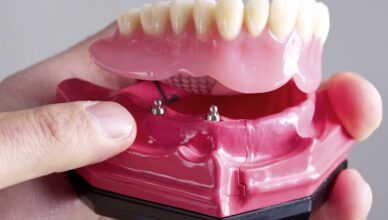 implant retained dentures